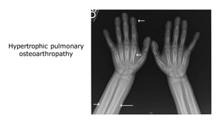 Hypertrophic pulmonary
osteoarthropathy
 
