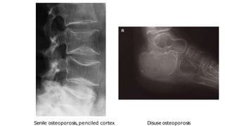 Disuse osteoporosis
Senile osteoporosis,penciled cortex
 