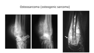 Osteosarcoma (osteogenic sarcoma)
 