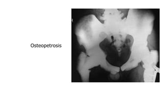 Osteopetrosis
 
