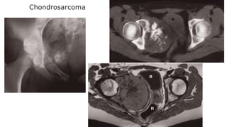 Chondrosarcoma
 