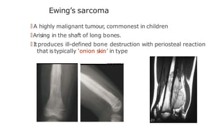 Ewing’s sarcoma
🠶 A highly malignant tumour, commonest in children
🠶Arising in the shaft of long bones.
🠶 Itproduces ill-defined bone destruction with periosteal reaction
that istypically ‘onion skin’ in type
 