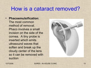How is a cataract removed? Phacoemulsification : The most common method of removal. Phaco involves a small incision on the side of the cornea.  A tiny probe is inserted which emits ultrasound waves that soften and break up the cloudy center of the lens so it can be removed with suction 