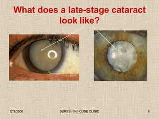 What does a late-stage cataract look like? 