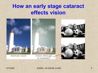How an early stage cataract  effects vision  