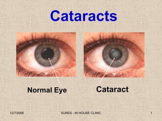 Cataracts



            Normal Eye                  Cataract

12/7/2006           SURES - IN HOUSE CLINIC        1
 