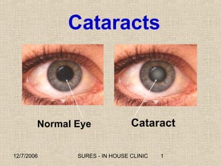 Cataracts



        Normal Eye              Cataract

12/7/2006      SURES - IN HOUSE CLINIC   1
 