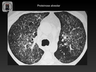 Proteinose alveolar
 