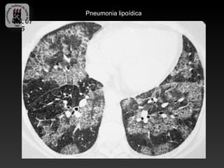 Pneumonia lipoídica
 