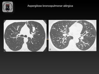 Aspergilose broncopulmonar alérgica
 