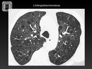 LInfangioleiomiomatose
 