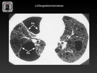 LInfangioleiomiomatose
 
