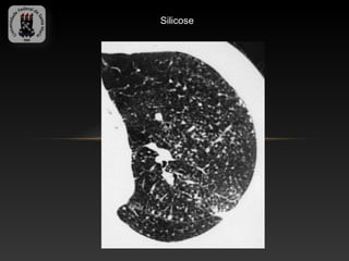 Silicose
 