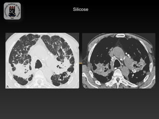 Silicose
 