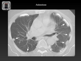 Asbestose
 