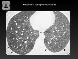 Pneumonia por hipersensibilidade
 