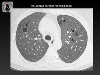 Pneumonia por hipersensibilidade
 