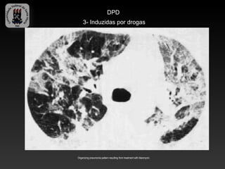 DPD
    3- Induzidas por drogas




Organizing pneumonia pattern resulting from treatment with bleomycin.
 