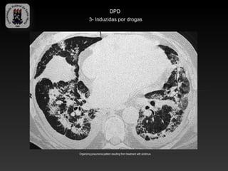 DPD
         3- Induzidas por drogas




Organizing pneumonia pattern resulting from treatment with sirolimus.
 