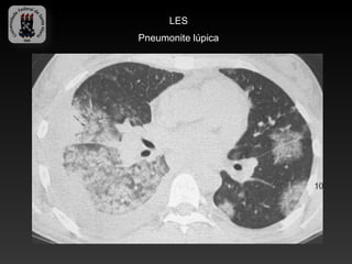 LES
Pneumonite lúpica
 