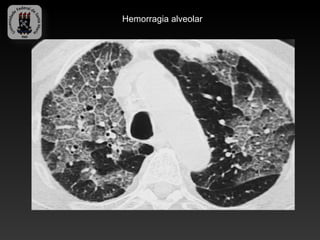 Hemorragia alveolar
 