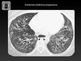 Esclerose sistêmica progressiva
 
