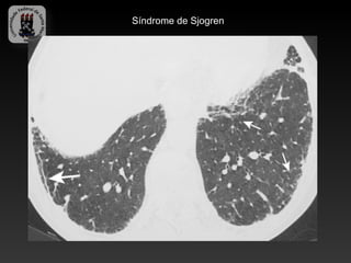Síndrome de Sjogren
 
