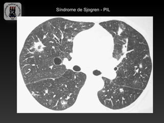 Síndrome de Sjogren - PIL
 