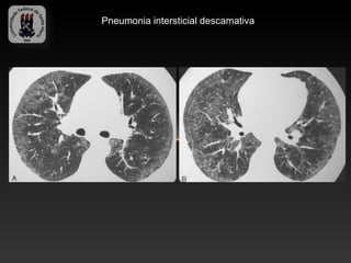 Pneumonia intersticial descamativa
 