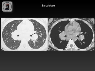 Sarcoidose
 