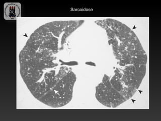 Sarcoidose
 