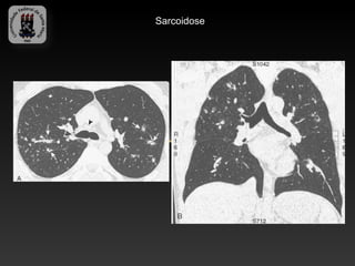 Sarcoidose
 