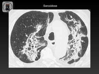Sarcoidose
 