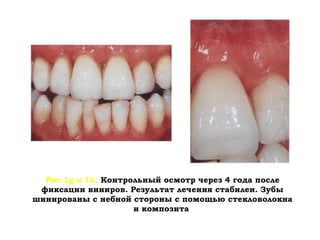 • Если в одном и том же зубном ряду имеется
несколько дефектов разной локализации, то в
этом случае зубную дугу относят к меньшему
по разряду классу.
Например: 7654300 0034000
0004300 0004560
Здесь имеются на верхней челюсти дефекты
четвертого и второго класса. В этом случае
верхний зубной ряд относят ко второму
классу, а нижний зубной ряд - к первому.
 