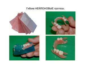 Гибкие НЕЙЛОНОВЫЕ протезы.
 