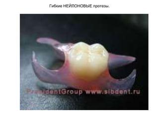 Гибкие НЕЙЛОНОВЫЕ протезы.
 