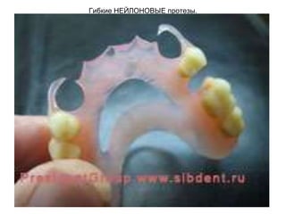 Гибкие НЕЙЛОНОВЫЕ протезы.
 