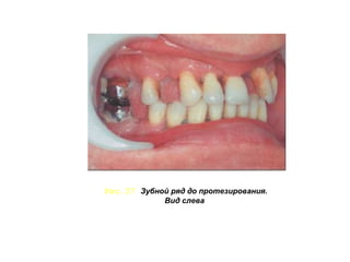 Имплантация при
недостатке костной ткани –
без трансплантации
аутогенного материала
с одномоментной
аугментацией
после аугментации (3 и более
месяцев)
1.2.2 Челюстно-лицевая:
фиксаторы челюстно-лицевых
протезов
фиксаторы слуховых
аппаратов
лицевые фиксаторы
 