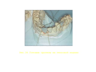 Рис.34 Готовые протезы на гипсовой модели
 