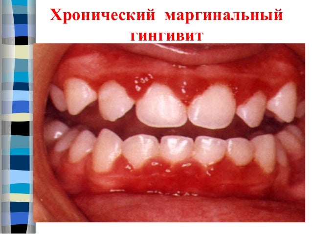 Болит с левой стороны спины отдает в ногу