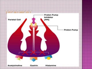 Parietal Cell
AcetyIchpline Gastrin
Proton Pump
Inhibitor
(PPI)
Proton Pump
Histamine
 