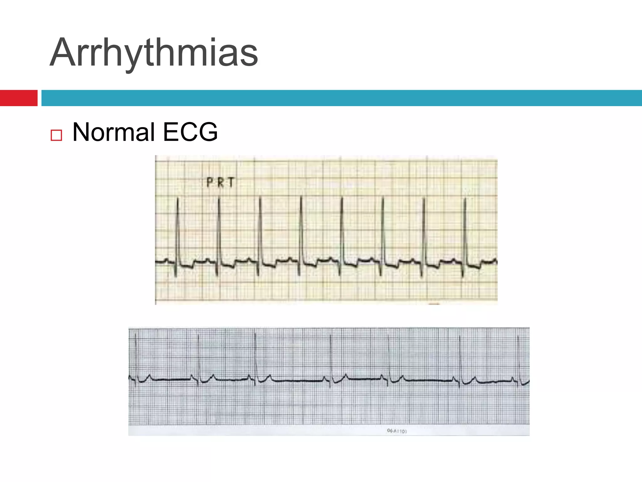 Arrhythmias
 Normal ECG
 
