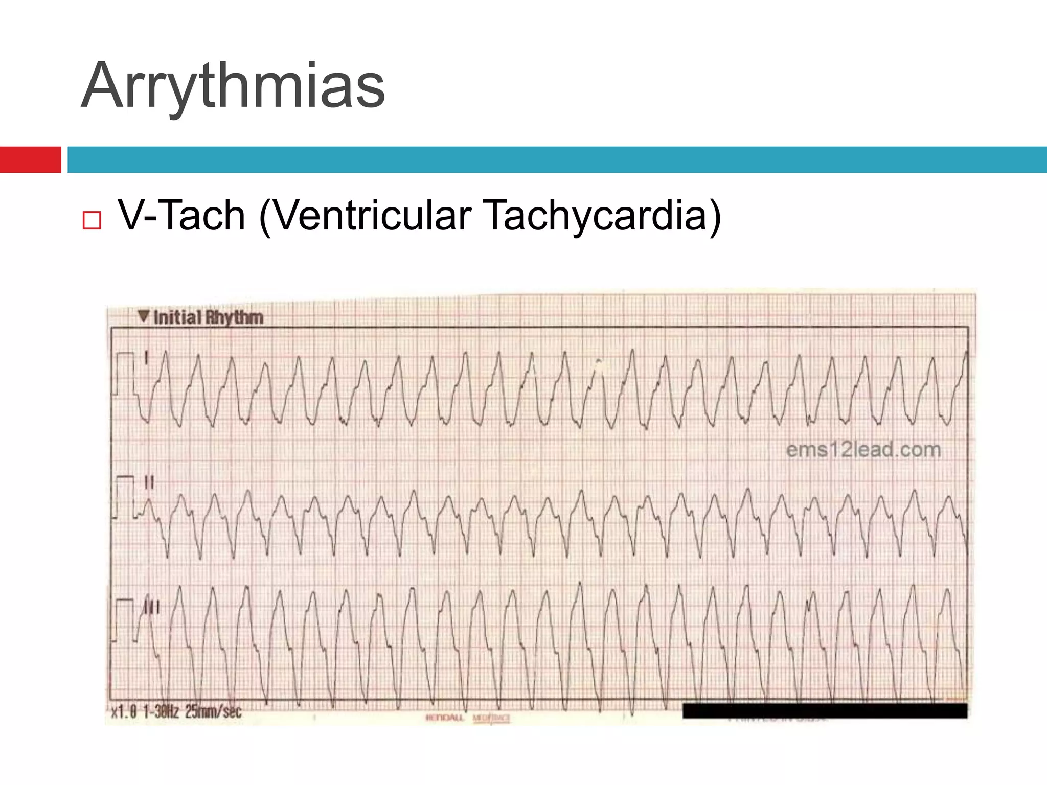 Arrythmias
 V-Tach (Ventricular Tachycardia)
 