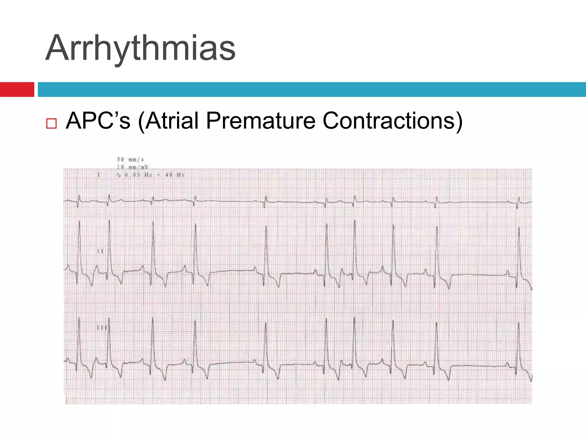 Arrhythmias
 APC’s (Atrial Premature Contractions)
 