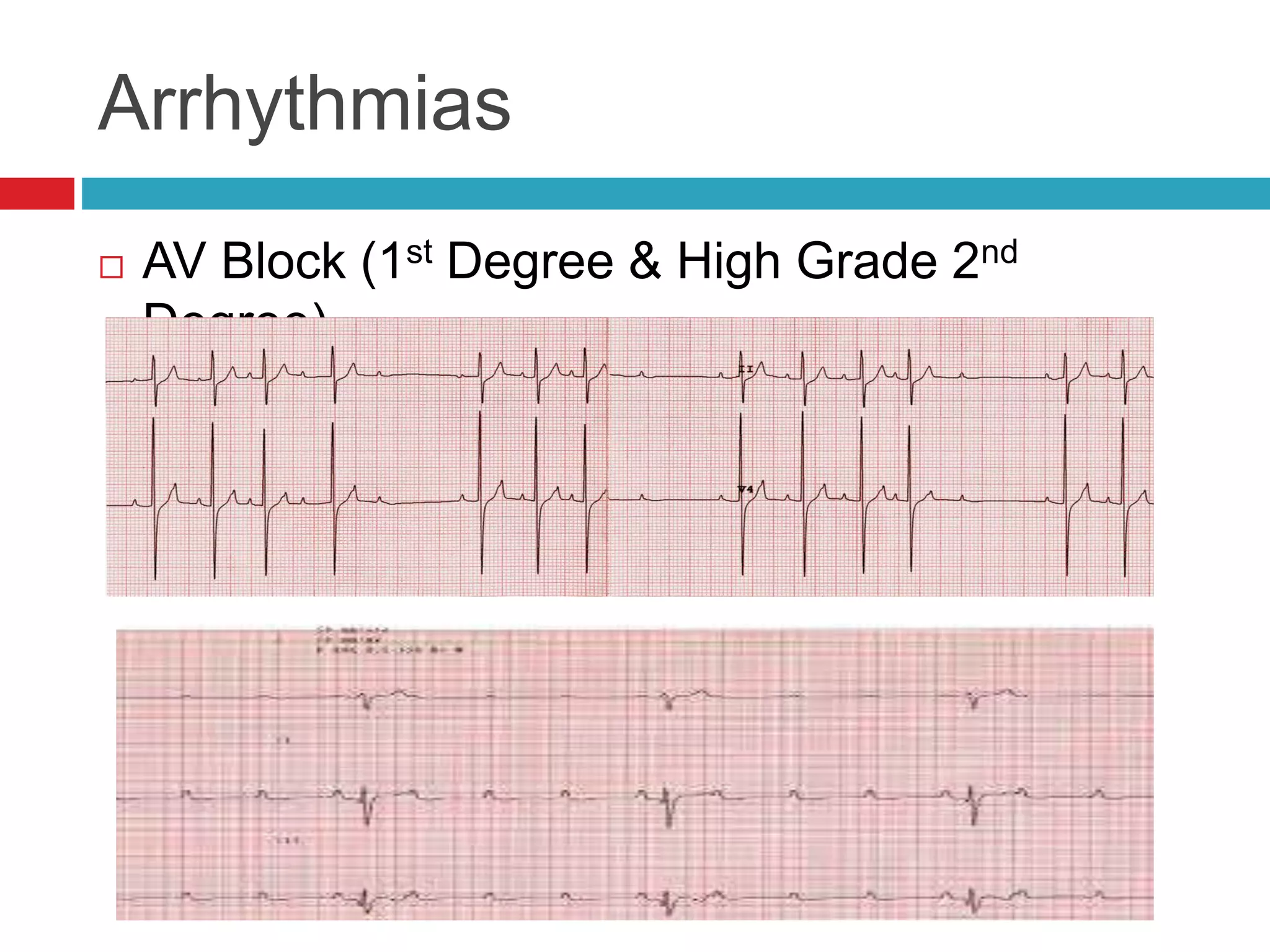 Arrhythmias
 AV Block (1st Degree & High Grade 2nd
Degree)
 