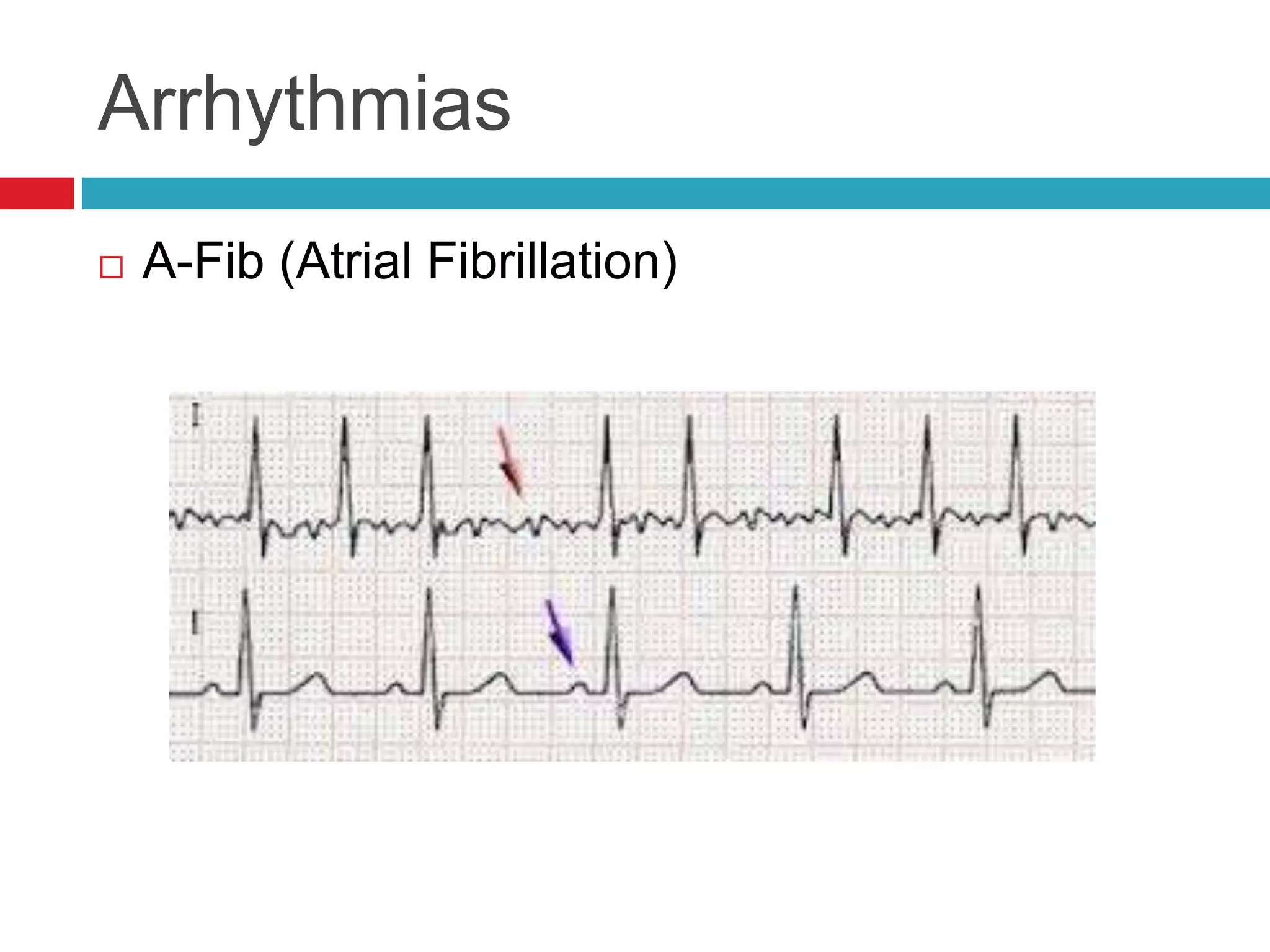 Arrhythmias
 A-Fib (Atrial Fibrillation)
 