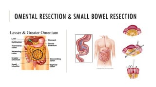 OMENTAL RESECTION & SMALL BOWEL RESECTION
 