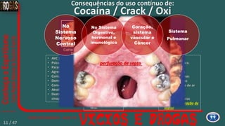 • AVC (derrame)
• Psicose.
• Paranoia.
• Agressividade.
• Coma.
• Demência.
• Convulsão.
• Atrofia cerebral
• Destruição das
sinapses.
• Hepatites.
• AIDS.
• D. S. T. (s)
• Diarreia.
• Descalcificação
(perda dos dentes e
ossos fracos).
• Alterações do ciclo
menstrual.
• Aborto.
• Mal formação do
feto.
• Rinite.
• Sinusite crônica.
• Enfisema.
• Sangramento
nasal/pulmonar.
• Destruição dos
alvéolos (falta de ar
crônica).
• Embolia.
• Necrose das vias
aéreas (perfuração de
septo)
• Tromboses.
• Pressão alta.
• Taquicardia.
• Aneurisma de
aorta.
• Perda de Peso.
• Câncer: cerebral,
pulmonar e vias
aéreas.
Cocaína / Crack / Oxi
Consequências do uso contínuo de:
perfuração de septo
No
Sistema
Nervoso
Central
No Sistema
Digestivo,
hormonal e
imunológico
Sistema
Pulmonar
Coração,
sistema
vascular e
Câncer
11 / 47
 