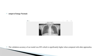 Advanced Pneumonia Detection Using Deep Learning and CNN | PPTX