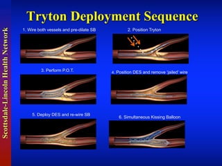 Scottsdale-LincolnHealthNetwork
Tryton Deployment Sequence
1.  Wire  both  vessels  and  pre-­dilate  SB 2.  Position  Tryton
3.  Perform  P.O.T. 4.  Position  DES  and  remove  ‘jailed’  wire
5.  Deploy  DES  and  re-­wire  SB
6.  Simultaneous  Kissing  Balloon
 